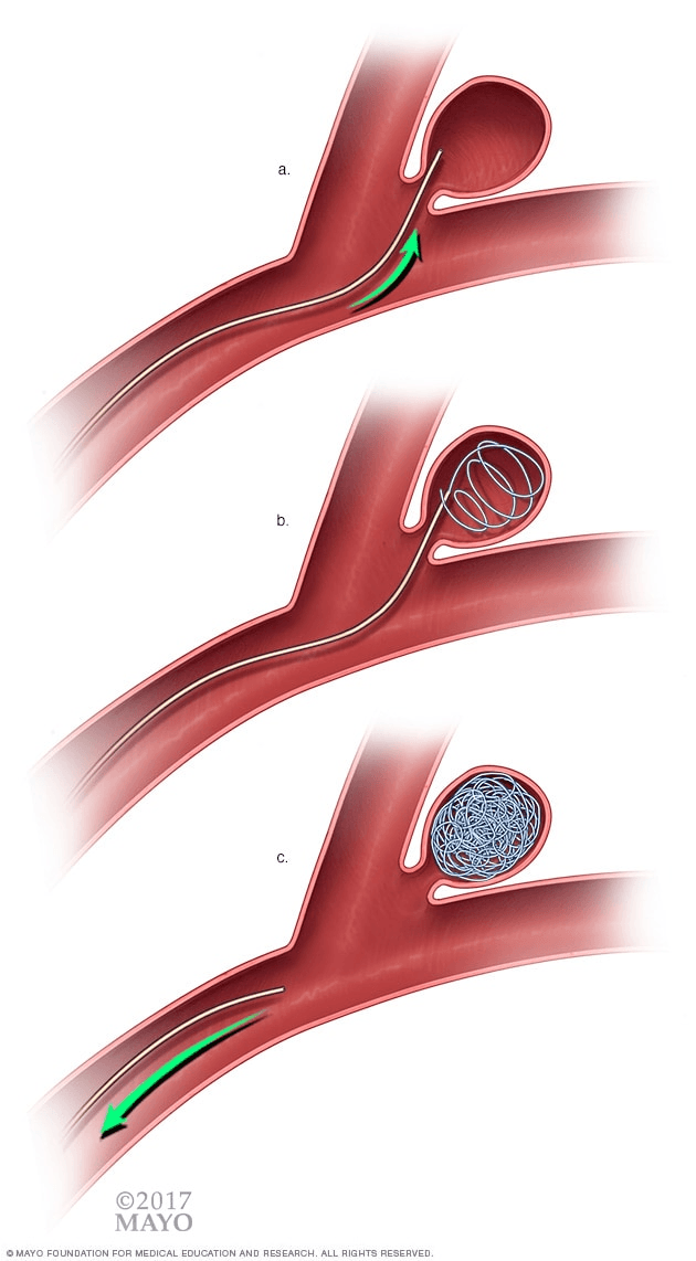 A medical illustration of a microcatheter entering the sac of the aneurysm and showing the deployment of platinum coils to fill the aneurysm. This procedure is called endovascular coil embolization.