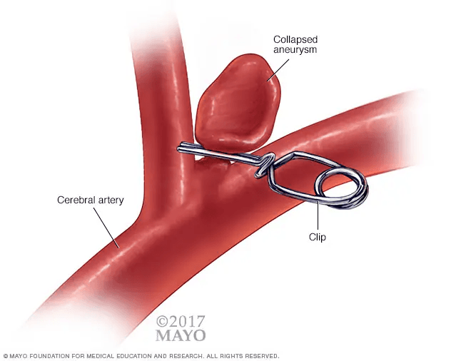 A medical illustration of a bifurcation aneurysm with a surgical clip strangling the neck of the aneurysm.